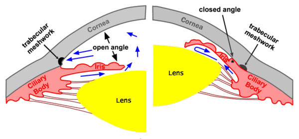 Ch 9. Glaucoma Emergency Acute angle closure glaucoma. A